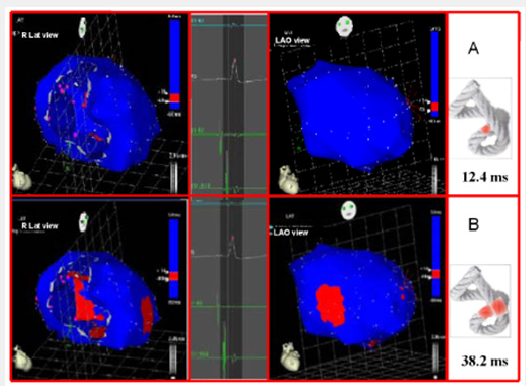 Click here to view Large Scheme 1 Lupinepublishers-openaccess-cardiology