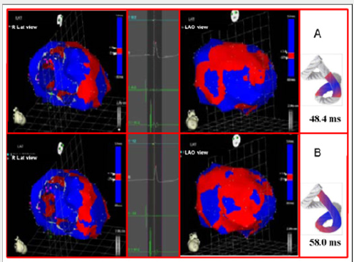 Click here to view Large Scheme 1 Lupinepublishers-openaccess-cardiology
