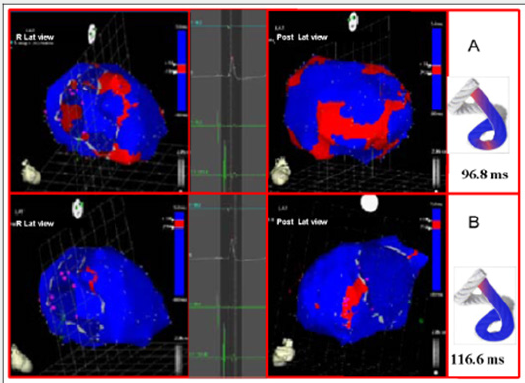 Click here to view Large Scheme 1 Lupinepublishers-openaccess-cardiology