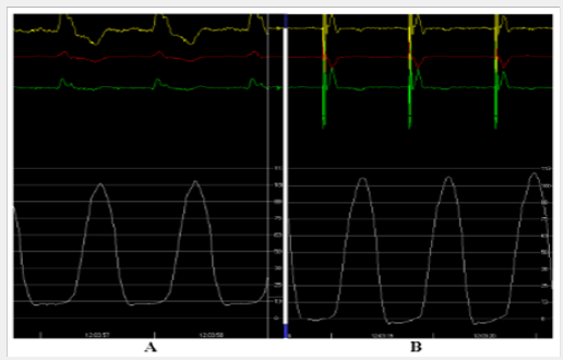 Click here to view Large Scheme 1 Lupinepublishers-openaccess-cardiology