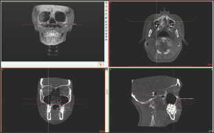 Click here to view Large Figure 1 Lupinepublishers-openaccess-dentistry-oral-healthcare