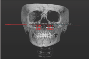 Click here to view Large Figure 3 Lupinepublishers-openaccess-dentistry-oral-healthcare