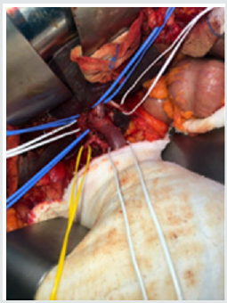 lupinepublishers-openaccess-journal-gastroenterology-hepatology