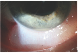 Click here to view Large Figure 1 Lupinepublishers-openaccess-Ophthalmology