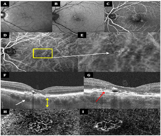 Click here to view Large Scheme 1 Lupinepublishers-openaccess-Ophthalmology
