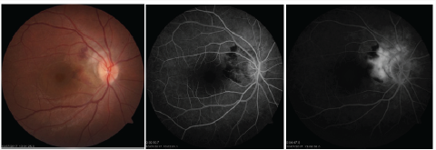 Click here to view Large Scheme 1 Lupinepublishers-openaccess-Ophthalmology