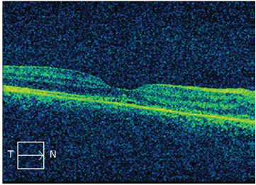 Click here to view Large Scheme 1 Lupinepublishers-openaccess-Ophthalmology