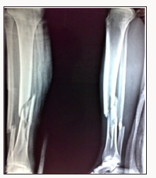 Click here to view Large Scheme 1 Lupinepublishers-openaccess-Surgery-Casestudies