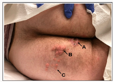 Click here to view Large Scheme 1 Lupinepublishers-openaccess-Surgery-Casestudies
