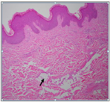Click here to view Large Scheme 1 Lupinepublishers-openaccess-Surgery-Casestudies