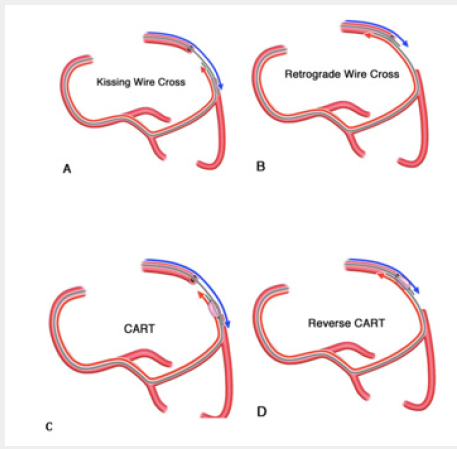 Click here to view Large Figure 1 Lupinepublishers-openaccess-cardiology
