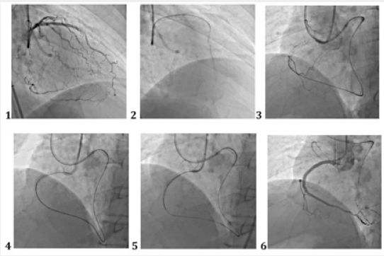 Click here to view Large Figure 2 Lupinepublishers-openaccess-cardiology