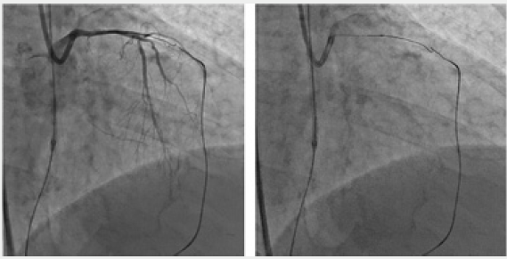 Click here to view Large Figure 3 Lupinepublishers-openaccess-cardiology