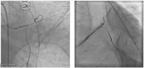 Click here to view Large Figure 5 Lupinepublishers-openaccess-cardiology