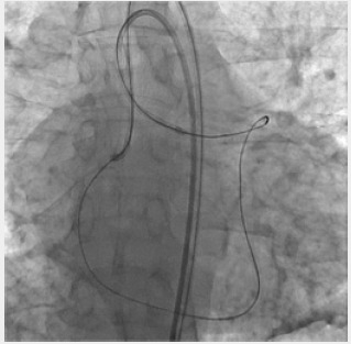 Click here to view Large Figure 6 Lupinepublishers-openaccess-cardiology