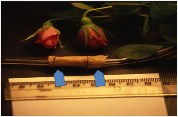 Click here to view Large Figure 4 Lupinepublishers-openaccess-cardiology