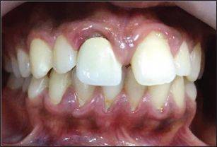 Click here to view Large Figure 1 Lupinepublishers-openaccess-dentistry-oral-healthcare