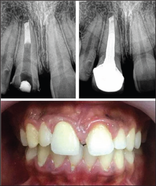 Click here to view Large Figure 3 Lupinepublishers-openaccess-dentistry-oral-healthcare