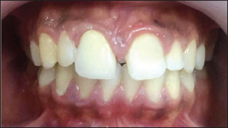 Click here to view Large Figure 4 Lupinepublishers-openaccess-dentistry-oral-healthcare