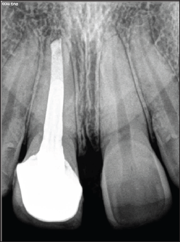 Click here to view Large Figure 5 Lupinepublishers-openaccess-dentistry-oral-healthcare