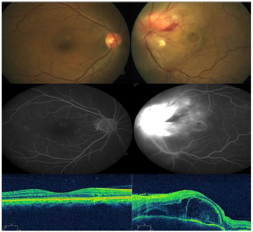 Click here to view Large Scheme 1 Lupinepublishers-openaccess-Ophthalmology