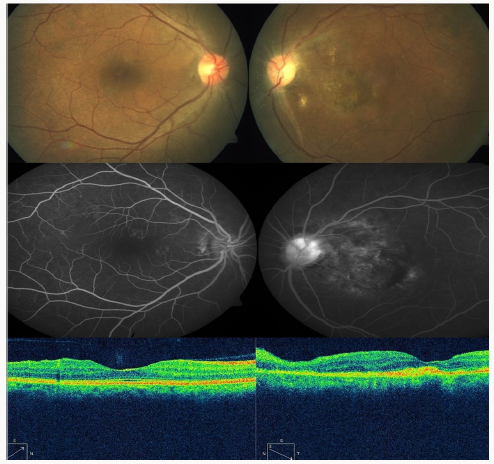 Click here to view Large Scheme 1 Lupinepublishers-openaccess-Ophthalmology