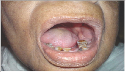 Click here to view Large Figure 1 lupinepublishers-openaccess-journal-pediatric-dentistry