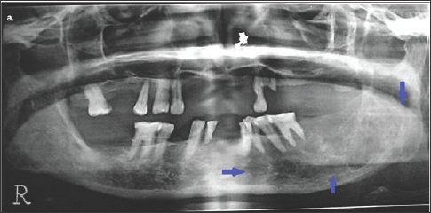 Click here to view Large Figure 2 lupinepublishers-openaccess-journal-pediatric-dentistry