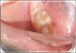Click here to view Large Figure 1 lupinepublishers-openaccess-journal-pediatric-dentistry