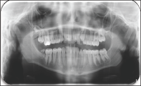 Click here to view Large Figure 2 lupinepublishers-openaccess-journal-pediatric-dentistry