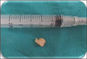 Click here to view Large Figure 3 lupinepublishers-openaccess-journal-pediatric-dentistry