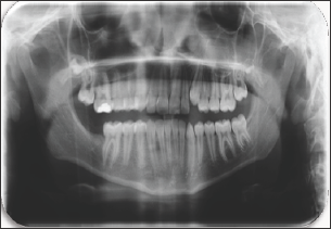 Click here to view Large Figure 4 lupinepublishers-openaccess-journal-pediatric-dentistry
