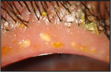 Click here to view Large Figure 11 lupinepublishers-openaccess-journal-respiratory-skin-diseases