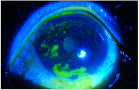 Click here to view Large Figure 15 lupinepublishers-openaccess-journal-respiratory-skin-diseases