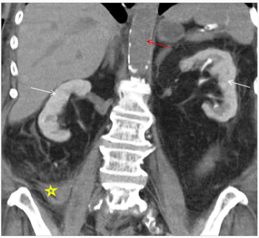 Click here to view Large Figure 1 lupinepublishers-openaccess-journal-urology-nephrology